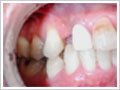 前歯部1歯欠損術前
