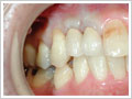 前歯部1歯欠損術後