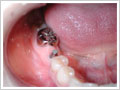 臼歯部1歯欠損術前
