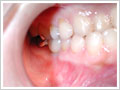 臼歯部1歯欠損術後