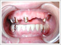 テレスコープアタッチメント義歯